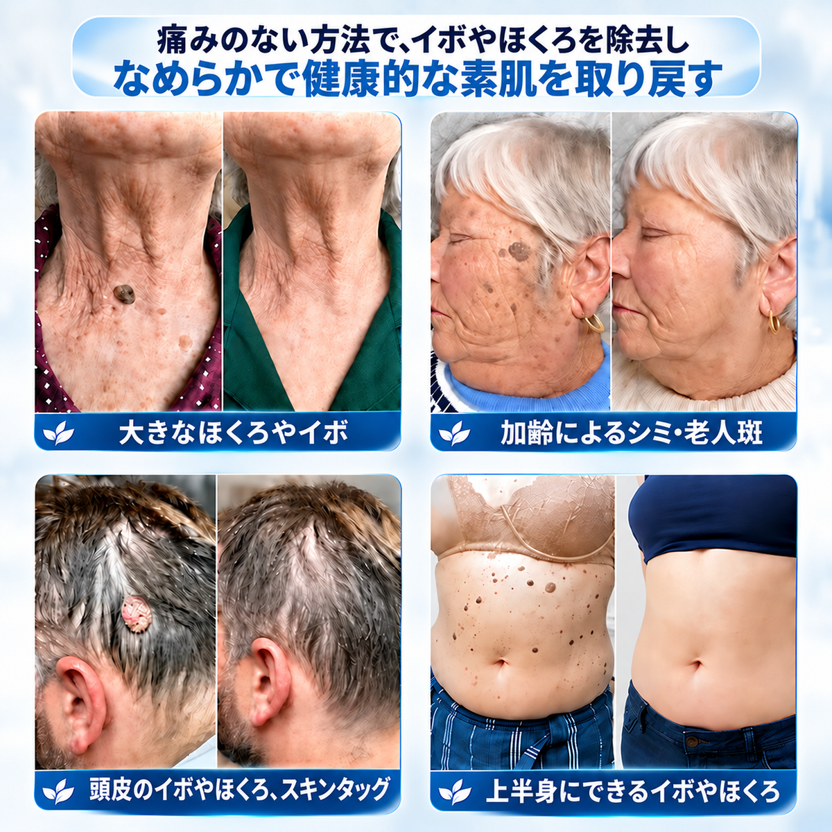 𝐇𝐞𝐚𝐥𝐫𝐢𝐳𝐞® 🥝🩵 肌のイボや気になる色素沈着を7日間集中ケア（やさしい処方で痛みなし・跡が残りにくい）🌿