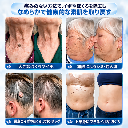𝐇𝐞𝐚𝐥𝐫𝐢𝐳𝐞® 🥝🩵 肌のイボや気になる色素沈着を7日間集中ケア（やさしい処方で痛みなし・跡が残りにくい）🌿