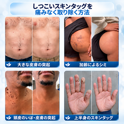𝐇𝐞𝐚𝐥𝐫𝐢𝐳𝐞® 🥝🩵 肌のイボや気になる色素沈着を7日間集中ケア（やさしい処方で痛みなし・跡が残りにくい）🌿