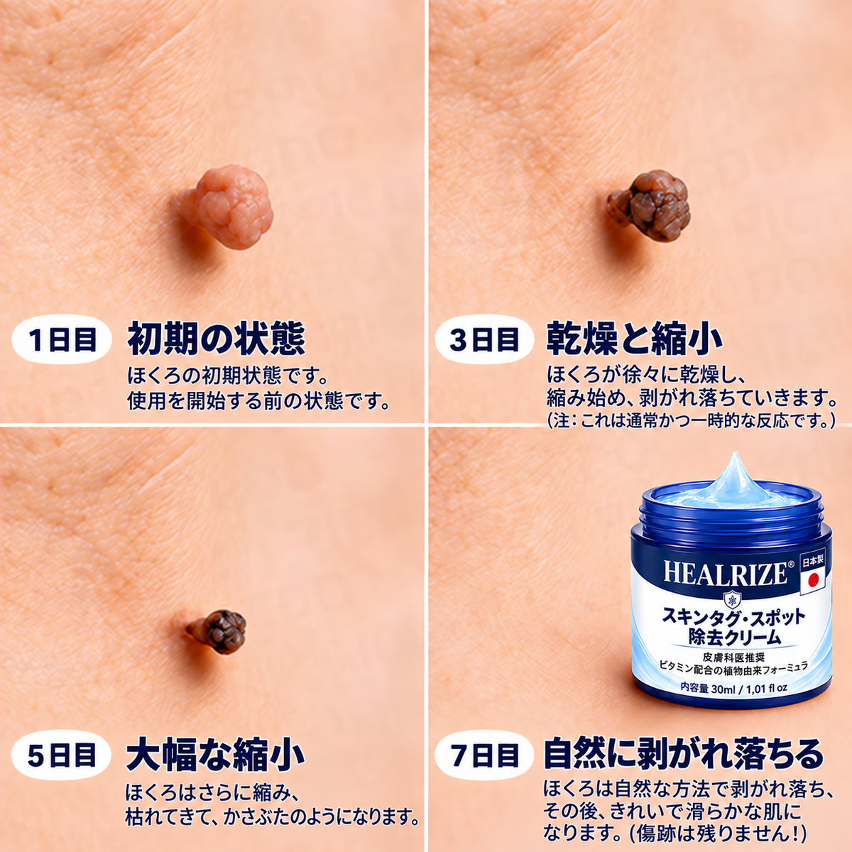 𝐇𝐞𝐚𝐥𝐫𝐢𝐳𝐞® 🥝🩵 肌のイボや気になる色素沈着を7日間集中ケア（やさしい処方で痛みなし・跡が残りにくい）🌿