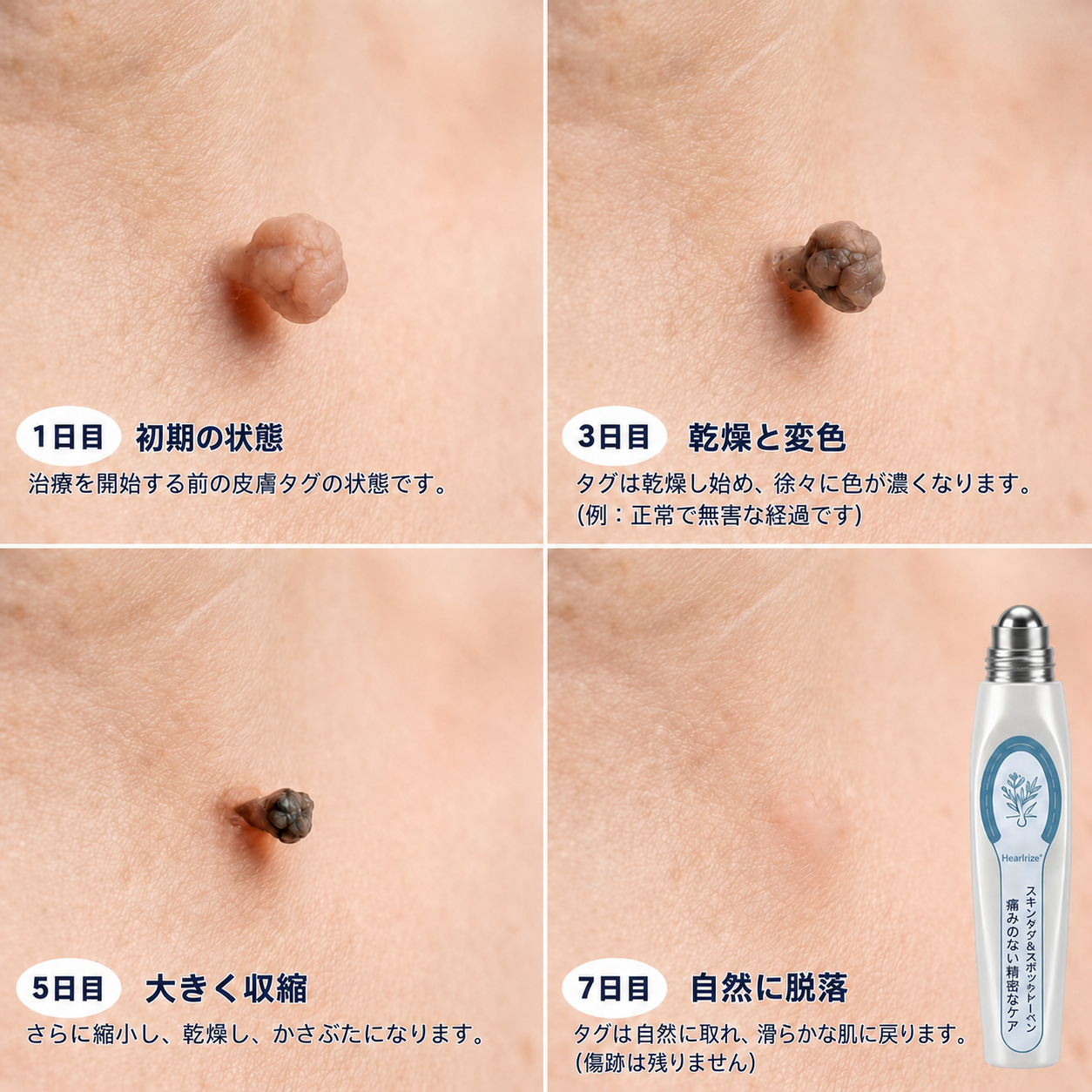 ✨薬剤師もおすすめ 𝑯𝗲𝙖𝐥𝒓𝗶𝙯𝗲® 7日間 タグ＆スポットイレーサー🪄 （痛みゼロ・傷あとゼロを目指すローラーボールタイプ）👩‍⚕️